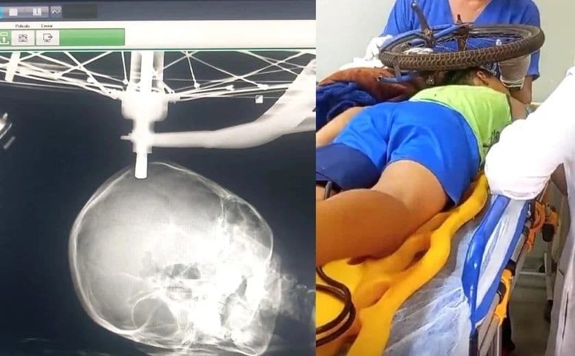 Criança cai de bicicleta e fica com a roda presa ao crânio em MG