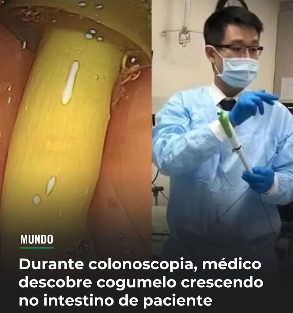 CHOCANTE! Médico encontra cogumelo crescendo no intestino de paciente durante colonoscopia em Taiwan